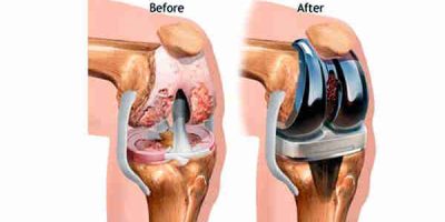 knee replacement surgery cost in hyderabad